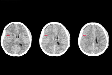 subdural hemorrhage and brain edema