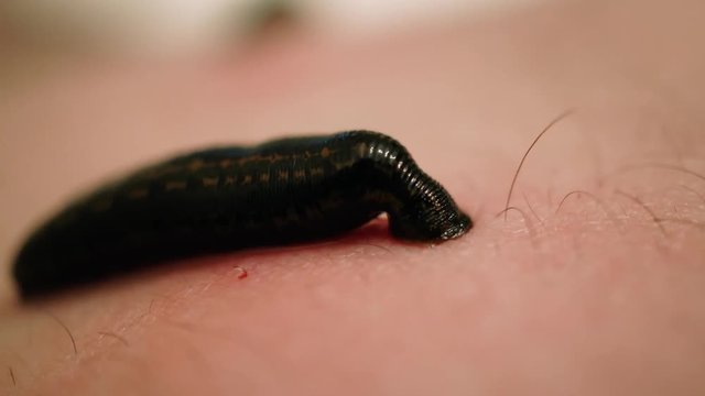 Treatment with leeches feet. Hirudotherapy in clinic - Leech on skin. Close up. Macro. 4K