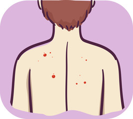 Symptoms Red Mole Or Papule Illustration
