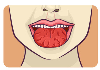 Symptoms Crack On Tongue Illustration