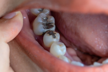 Dental fillings and dental caries.