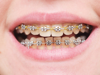 Teeth with braces