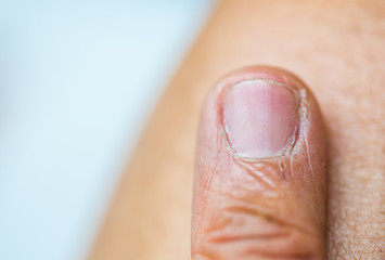 Finger nail have fungus