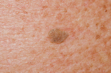 Birthmark of papilloma on the body of an old man close-up