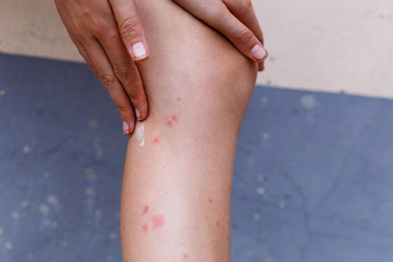 Scratch soft itchy red bumps on the skin from mosquito bites on left leg with hand, using therapeutic cream against itching