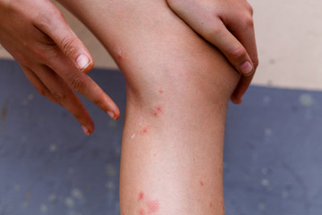 Women with his feet, itching on the lawn caused by insect bites and stings health and medical view and devising concepts. Medical cream