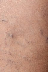Fototapeta premium Woman's leg with varicose veins, closeup