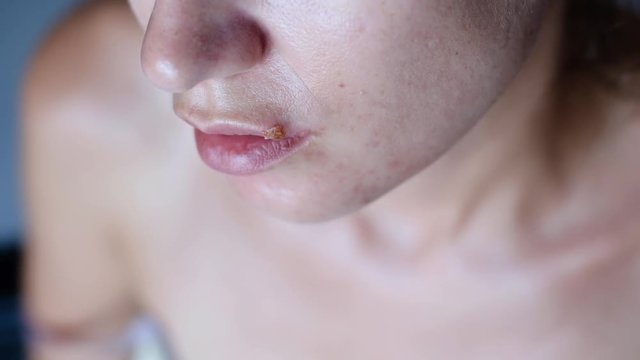 Girl suffers from herpes on her lips
