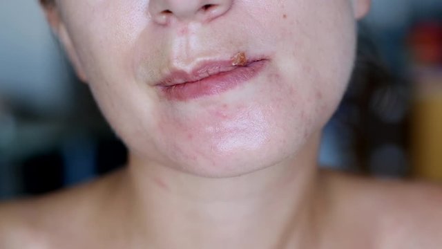 Girl touches herpes on her lips