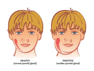 A vector medical illustration showing a healthy child next to on suffering from parotitis or inflammation of parotid glands.