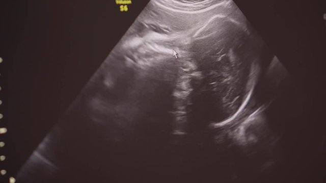 ultrasound image of a baby girl