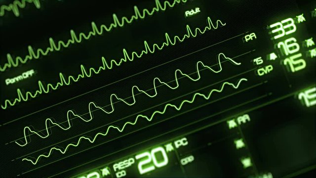 Multi-parameter patient monitor screen / Medical green screen interface. Screen with various measured  ST-segment and heart attack detection, pace-maker analysis, and arrhythmia analysis, all on a fea