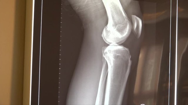 X ray of knee joint anatomy and leg bones in doctors office.