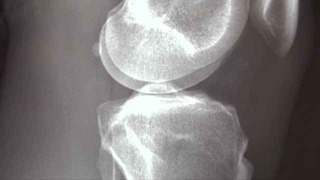 X ray of knee joint anatomy with tibia and fibula leg bones CLOSE UP.