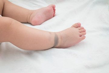The little feet with birthmark. This birthmark will disappear in the future. (Called Mongolian spot)