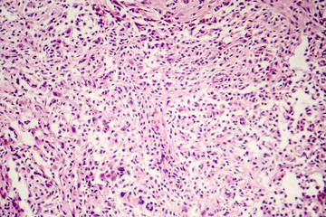 Foreign body granuloma, light micrograph, photo under microscope