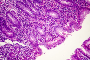 Fototapeta na wymiar Suppurative appendicitis, light micrograph, photo under microscope showing neutrophilic infiltrates of the appendix wall