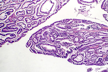Intestinal polypoid adenoma, light micrograph, photo under microscope