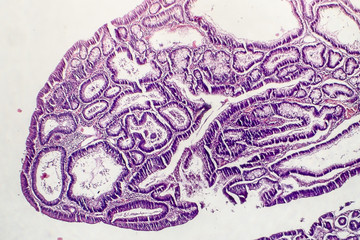 Intestinal polypoid adenoma, light micrograph, photo under microscope