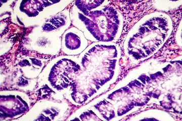 Intestinal polypoid adenoma, light micrograph, photo under microscope