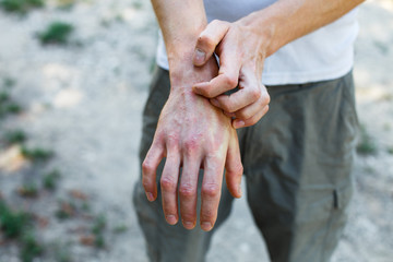 The problem of many people - eczema on hand. Street background. Man itchind psoriasis skin with red...