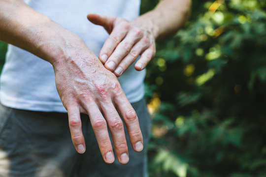 Ointment on hand. Applying the ointment in the treatment and hydration of the skin.Psoriasis skin. Horizontal photo