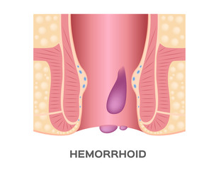 Hemorrhoids stage vector. ass and anus