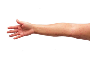 Women with symptoms of itchy urticaria