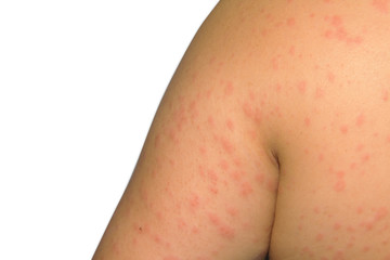 Women with symptoms of itchy urticaria