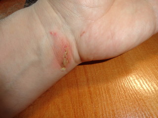 a purulent wound on the arm