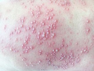 Close-up of leg of woman with pimples of Herpes zoster. Skin infected Herpes zoster virus on the leg