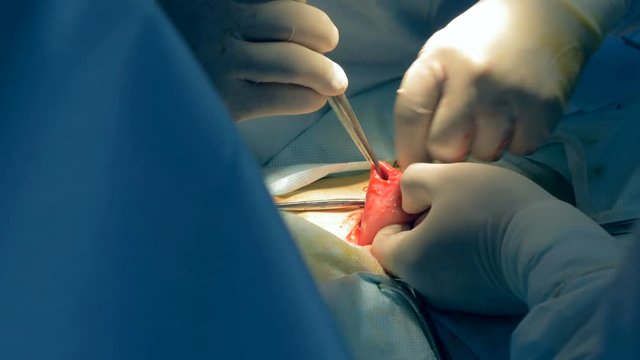 Surgeons are making an ostium in an organ during operation