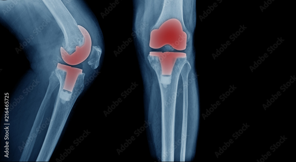 Sticker X-ray image, total knee artroplasty in blue tone