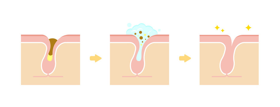Structure illustration of pores / Clear keratotic plug (whiteheads ,blackheads ) with cleansing. 