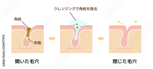 毛穴断面図イラスト 角栓 皮脂汚れの詰まった毛穴をクレンジングできれいにする様子 Wall Mural Barks 毛穴断面図イラスト 角栓 皮脂汚れの詰まった毛穴をクレンジングできれいにする様子 Wall Mural Barks