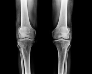 knee x-ray,OA knee in old man
