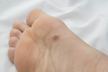 foot with problem areas on the skin.close up