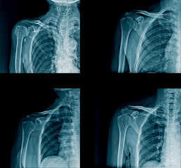 collection shoulder x-ray image