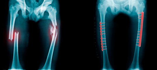 fracture of leg with post op fixation