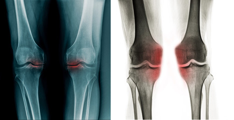 x-ray OA knee