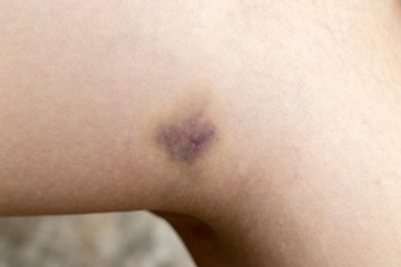 Closed up of bruise injury on female leg background