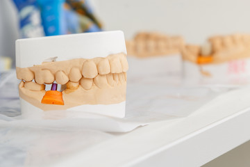 A prosthetic saddle in a dental laboratory
