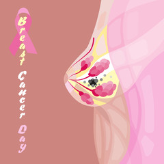 Breast cancer diagram illustration