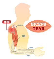 Biceps tear vector illustration. Labeled medical scheme with humerus, muscle, radius and ulna isolated closeup. Anatomical diagram with human arm, elbow and shoulder.