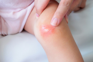 mother apply antiallergic cream at baby knee with skin rash and allergy with red spot cause by mosquito bite
