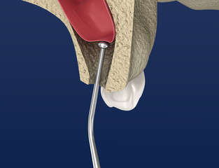 Sinus Lift Surgery - Sinus Augmentation. 3D illustration