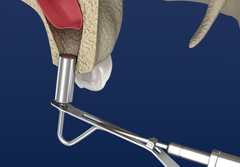 Sinus Lift Surgery - Sinus Augmentation. 3D illustration