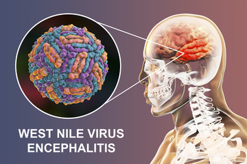 West Nile virus WNV encephalitis, 3D illustration showing brain infection and close-up view of WNV in the brain. Encephalitis in West Nile fever often affects temporal lobes, as shown here