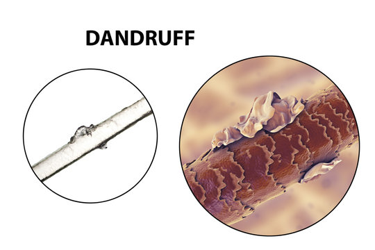 Human hair with dandruff, close-up view, photo under microscope and 3D illustration
