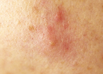 Fototapeta premium Redness from acne on the skin, cheek, macro, white-head